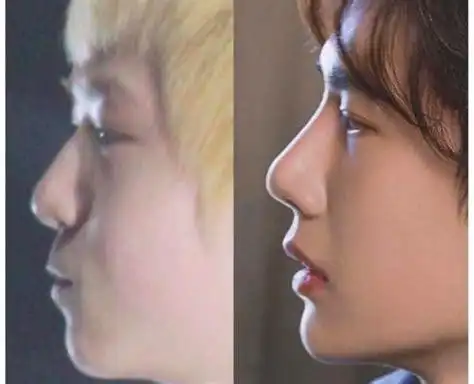 王一博出道前后对比照曝光疑整容 专家直言做过手术_好多料