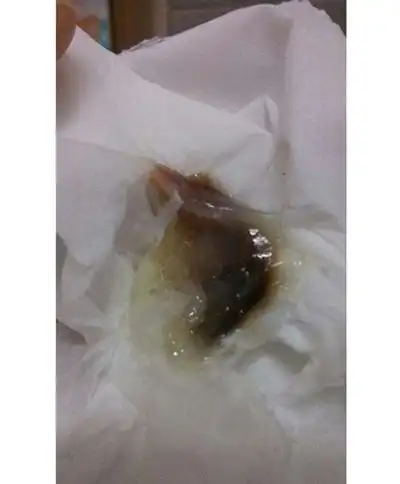 血性白带图片36