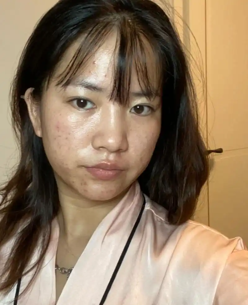 下面我将为您介绍如何改善油性痘痘肌肤,并提供一些有效的护肤建议.