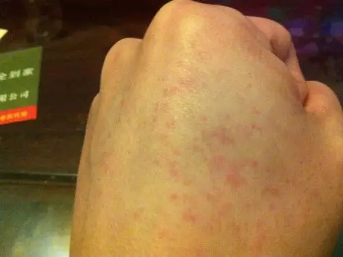 皮肤性病科 皮肤病 荨麻疹 你好,温医生:这几天手上张了很多的小红点