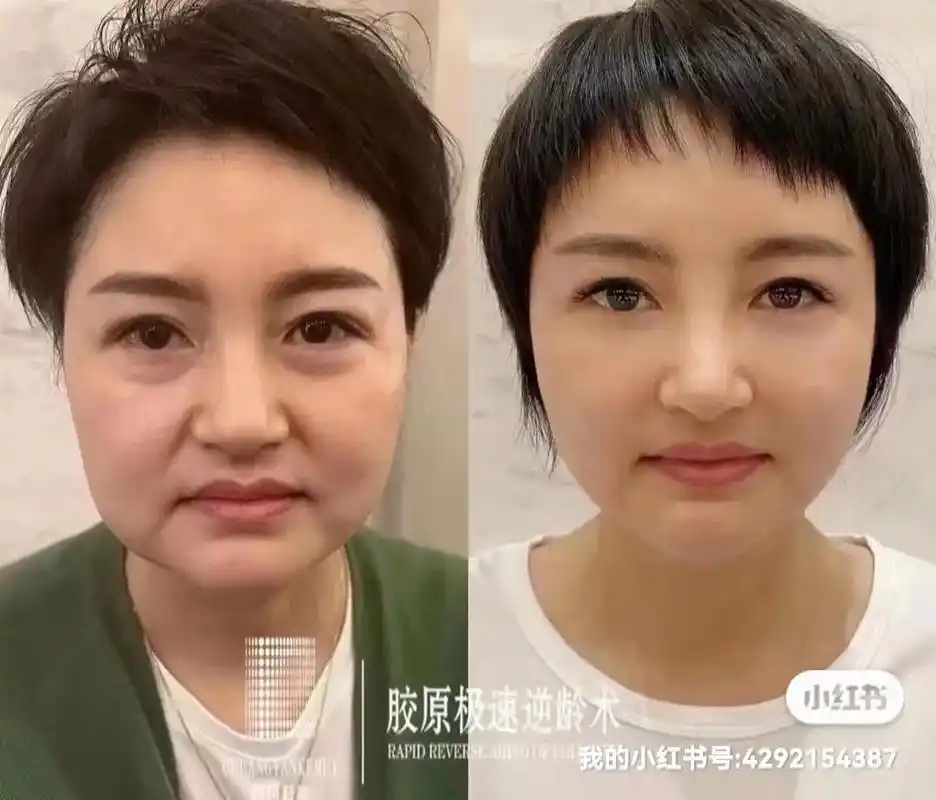 不手术不动刀无恢复期.玻尿酸 脂肪填充的时代已经过去了, 找 - 抖音