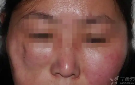 一般狼疮性脂膜炎和深在性狼疮是可以互换的synonym,比如gilliam分类