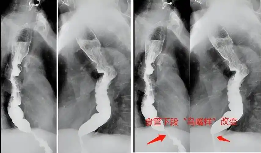 将水囊置在贲门狭窄处注水扩张3次,每次持续3分钟,贲门粘膜有轻度撕裂