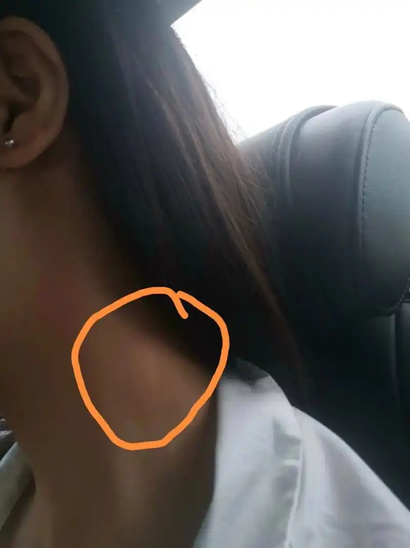 昨天脖子左侧突然长了一个小包,感觉里面是硬的,按着有疼痛感,还以为