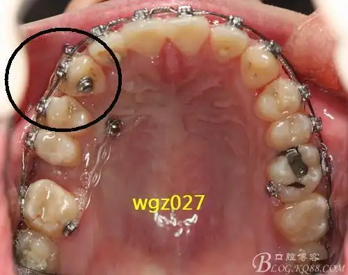 他那严重扭转的上颌尖牙正过来了吗?(原创)