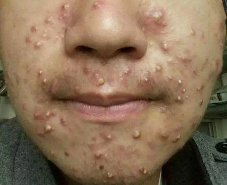 25岁以上还在长痘的人,这5个策略一定要坚持