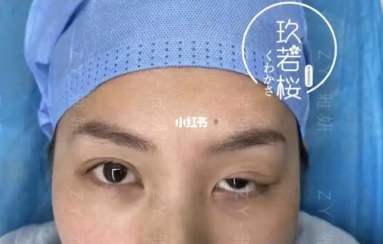 重度肌无力矫正双眼皮_肌无力_双眼皮_碧桂园金沙国际广场(里广新城店