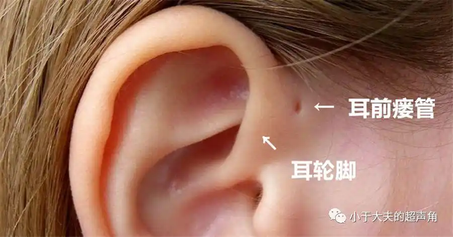 图2:耳前瘘管一般位于耳轮脚的前方紧邻处. .