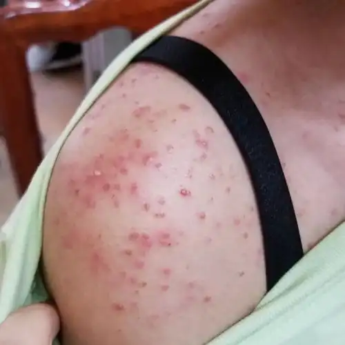 来夏季常见皮肤病:马拉色菌性毛囊炎 - 春雨医生