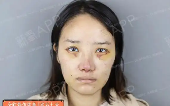 "binder综合症"又称先天性中面部凹陷,通俗点_圈子-新氧美容整形