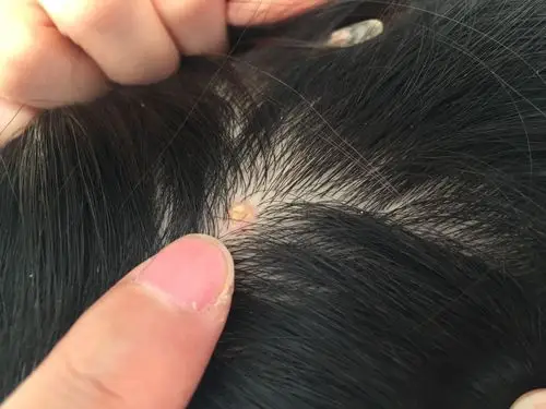 [求助]懂皮肤科的伙伴帮看看,头皮上长了一个黄色硬痂