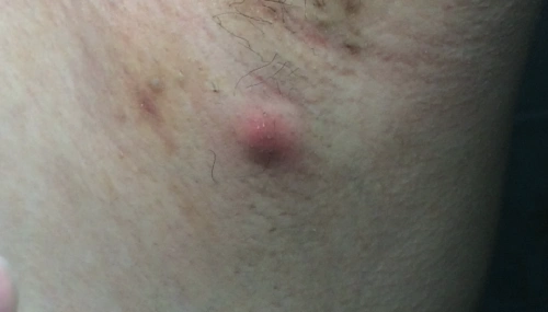 在门诊咨询的过程中,还有一个现象也让人头疼不已,那就是错把毛囊炎当