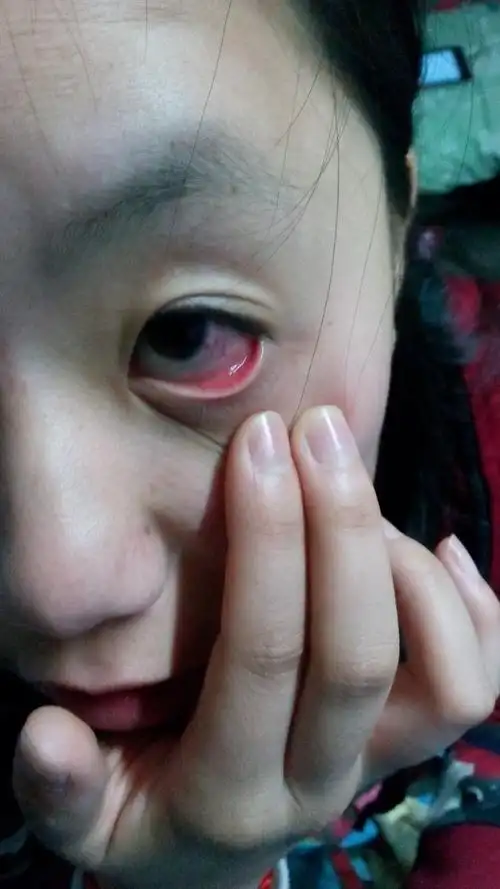 带了一段时间的隐形眼镜眼睛局部出现红血丝还隆起一个小白点