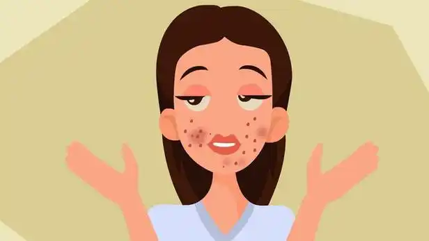 红霉素软膏只能拿来偶尔使用,像青春痘这种经常复发的情况并不适用