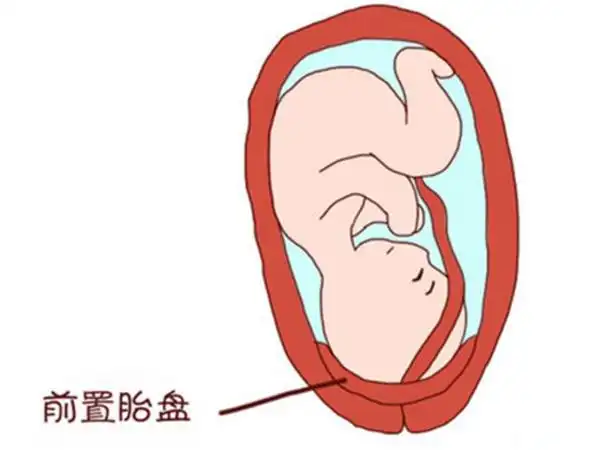 详述完全性前置胎盘剖腹产经历,大出血风险堪称"鬼门关"