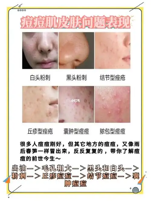 各种痘肌皮肤问题表现93