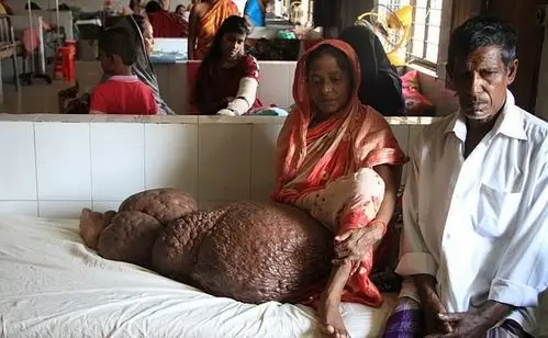 孟加拉女子腿部增生重达60公斤 疑患象皮病|象皮病|丝虫病|孟加拉国