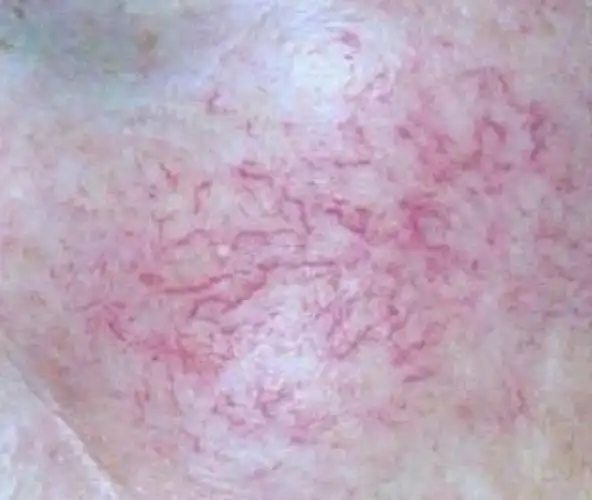 这样保养远离红血丝!