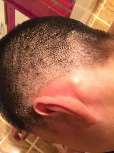 头皮里长小红痘痘,发痒