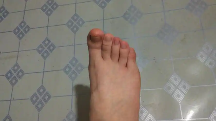 我的中脚趾有些弯曲,但不疼不影响跑步走路,可能是小时候出车祸造成的