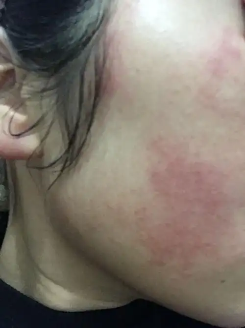 我的脸,十天之内过敏三次了,不知道咋回事,有没有医生帮忙看看