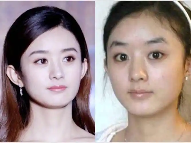 额头不饱满是可以通过自体脂肪填充额头,改善面部轮廓的 赵丽颖对额头