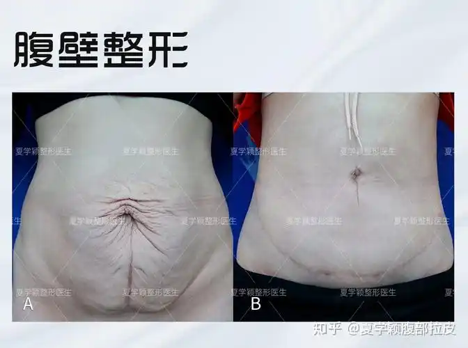 恢复得还不错,躯干和身材都瘦下来了,可是肚皮却依然是松松垮垮的状态