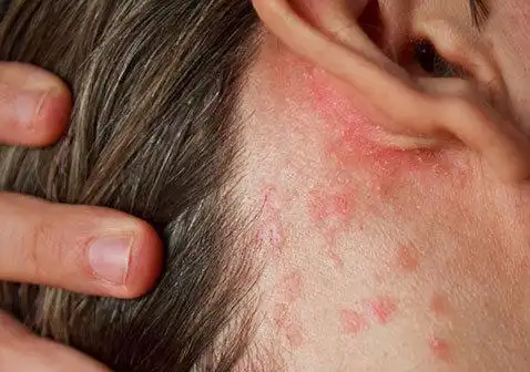 湿疹图片初期症状图片大全:耳朵,手掌手背,疱疹-中华银屑病网