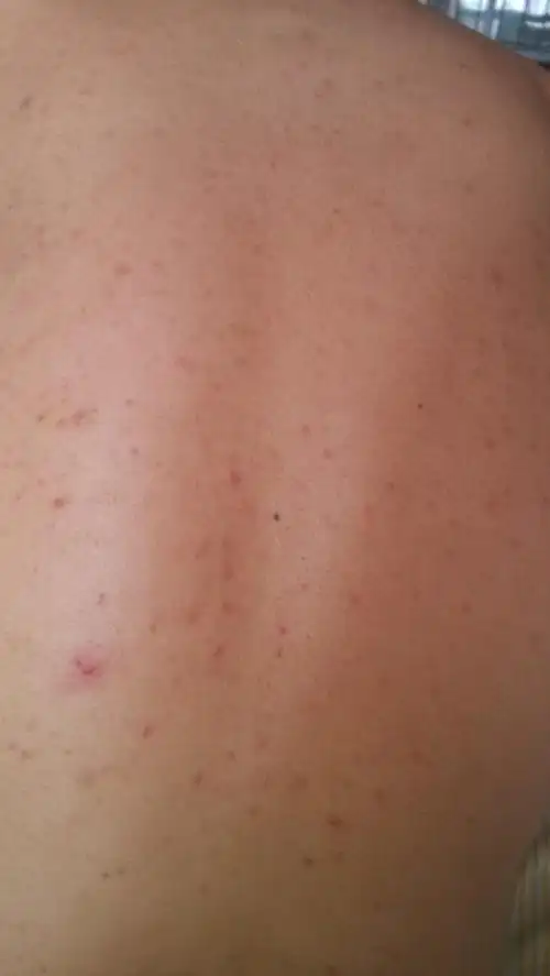 背部有几年了 以前也没怎么注意 现在有点严重 平时