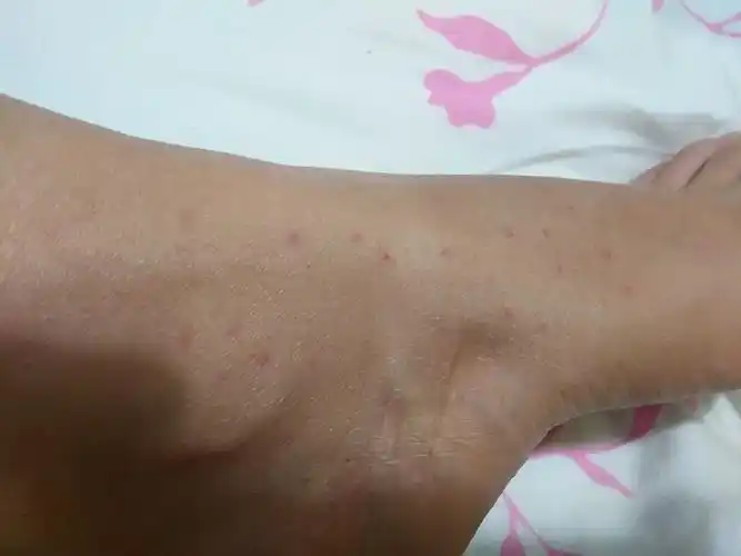 刚搬进一趟新装修的房,住了几天发现身上长了很多小红点,不痛不痒,是