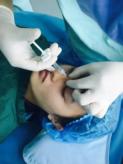 网易小编打玻尿酸改善驼峰鼻