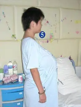 10岁女童患上巨乳症原因在哪里中医是这么看的