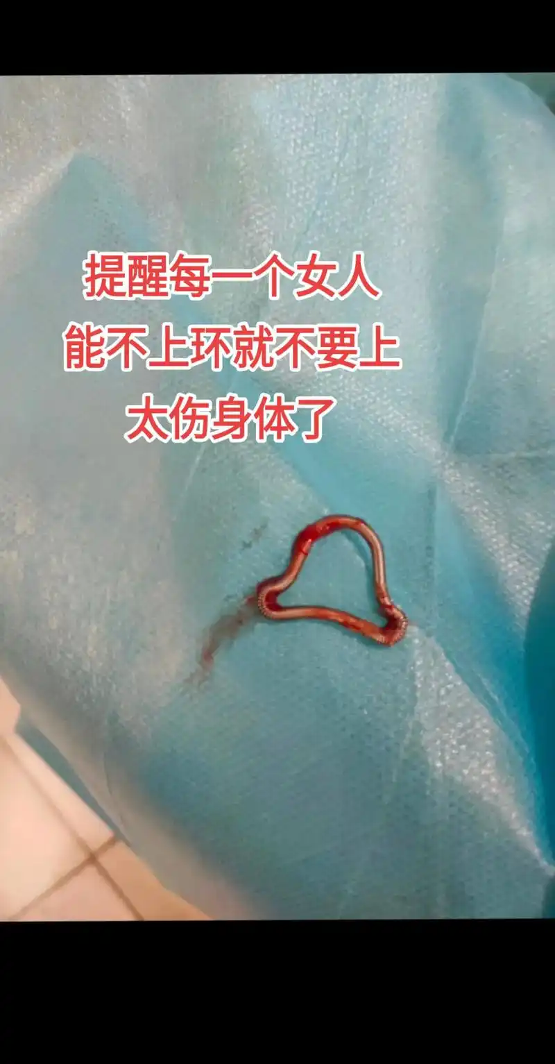 熬过了生孩子的痛,熬过了上环的痛,最终逃不过取环的痛,今天终 - 抖音