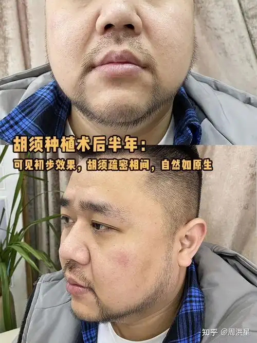 超全的胡须种植过程看北方小哥如何从奶气小生变身狂野汉子案例分享