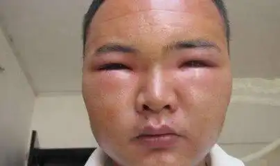 脸上出现3种标记,当心尿毒症已"上门"!