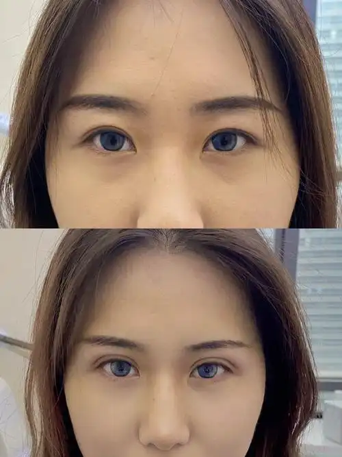 双眼皮77款平行大眼睛