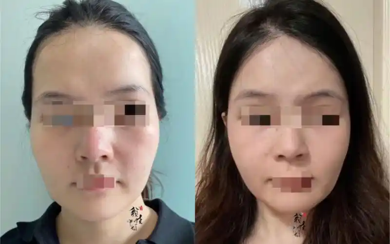 太阳穴凹陷填充后对比