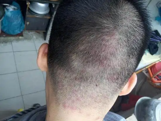 头皮有红疙瘩而且还痒怎么办头皮红疙瘩痒用什么药