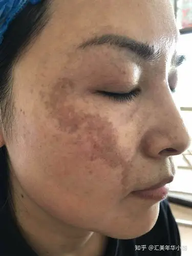 黄褐斑为什么说是皮肤屏障功能缺失