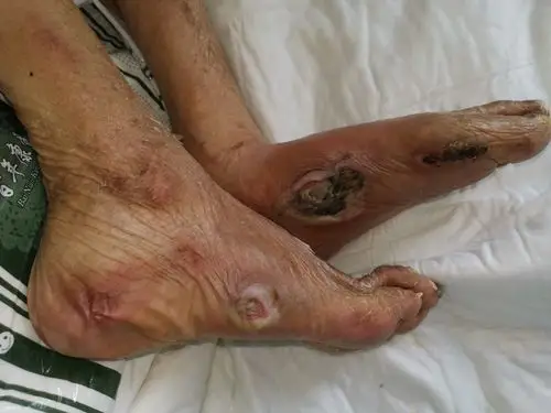 双足压疮～皮肤坏死感染