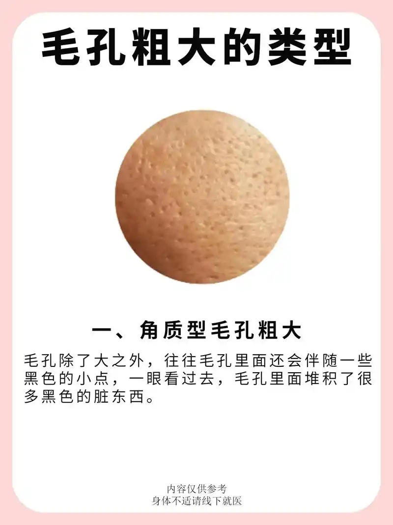 毛孔粗大的类型.#毛孔粗大 #图文伙伴计划 #护肤 #皮肤  - 抖音
