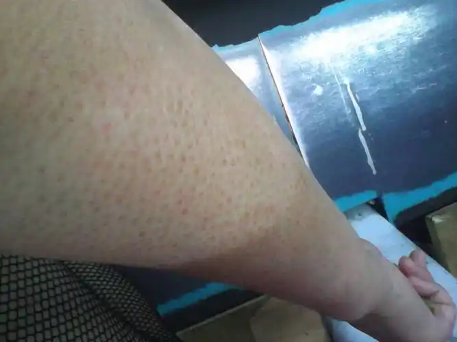 这样毛孔开口变得更小,更容易堵塞,会产生粉刺,毛囊炎;如果抓伤,更会