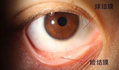 之所以叫结膜囊,是因为它以睑裂为口,角膜为底,结膜正好形成了一个囊