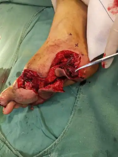 断足再植术后部分坏死,足底内皮瓣修复