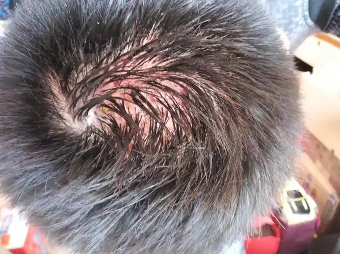 头部脓肿性穿凿性毛囊周围炎 求助