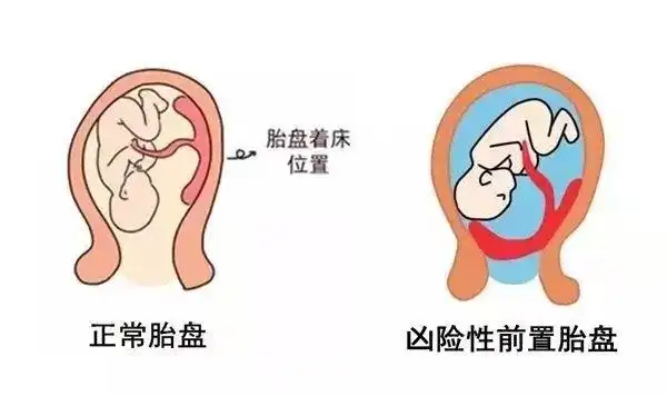 眉县妇保院成功抢救一例凶险性前置胎盘并胎盘植入产妇