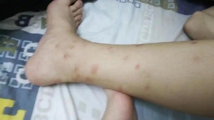 我腿上这半个月老是很痒,麻烦有了解的看一下是怎么回事,会不会是虫咬