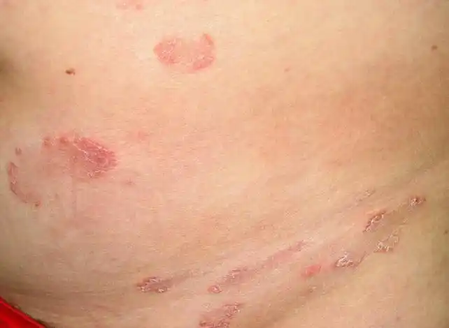 梅毒早期图片_梅毒早期图片女性 初期