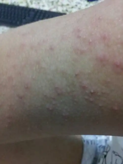 去年医生断定我是内分泌失调封闭性粉刺毛囊炎痤疮,现在这手臂不会是