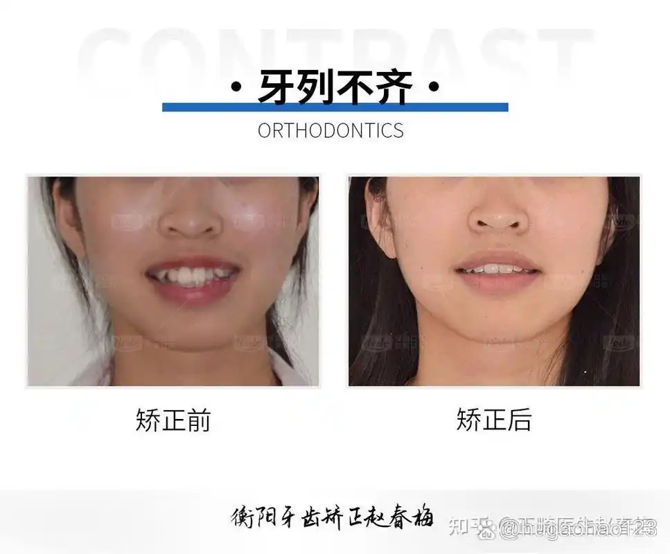 虎牙这么突出能矫正吗